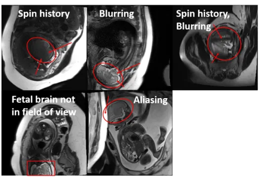 Figure 3-4: Representative examples of nondiagnostic quality fetal brain MRI connected components in the segmentations, bounding circles were applied and the largest bounding circle was taken as the brain (Fig
