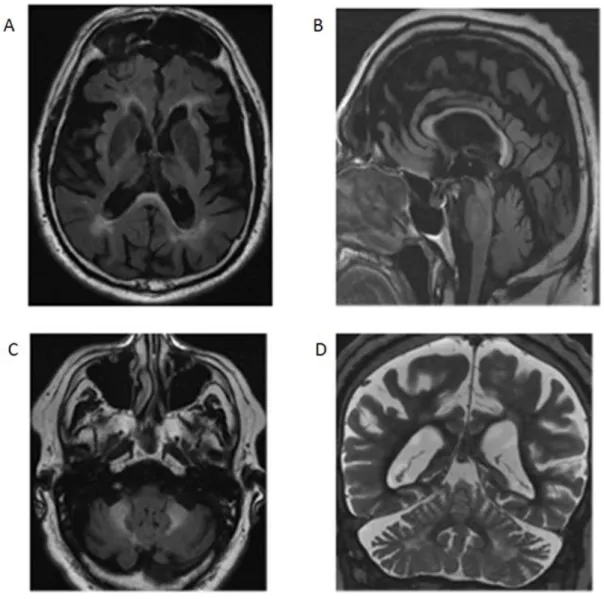 Figure 5:  IRM cérébrale avec coupes axiales et sagittale en séquence FLAIR (A, B et  C) et coupe coronale en séquence T2 (D) de patients FXTAS: noter l’atrophie  cortico-sous-corticale diffuse (A, B et D) avec atrophie du corps calleux (A et B) et cérébel