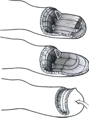 Figure  1-5:  The standard  transtibial amputation  restructures  residual  lower  leg  musculature and  tissue  to  provide  protection  to  distal  bone  ends  and  padding  for  prosthetic  socket  use.