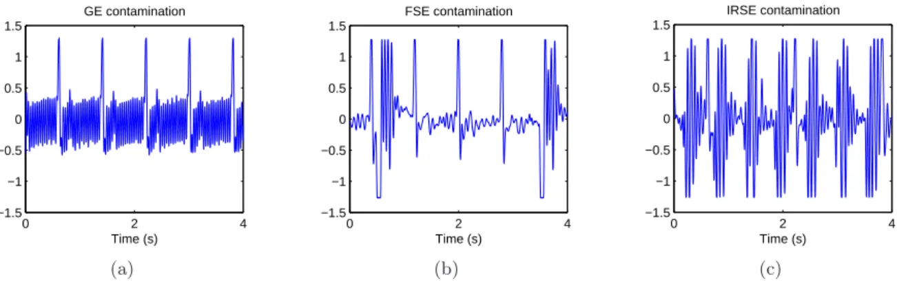 Fig. 1.10 – Contamination du signal ECG par les séquences