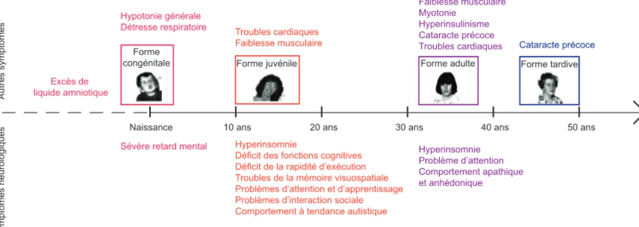 Figure II.1. Représentation schématique des différentes formes cliniques de la DM1. Les illustrations  des  patients  de  la  forme  congénitale,  juvénile,  adulte  et  tardive  illustrent  très  bien  le  phénomène  d’anticipation,  et  le  continuum  qu