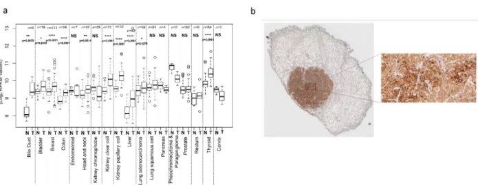 Fig 1. Analysis of MPV17 expression in cancer tissues. The Cancer Genome Atlas (TCGA), a public platform allowing the analysis of gene expression data sets generated by RNA sequencing (http://cancergenome.nih.gov), has been used to determine the expression