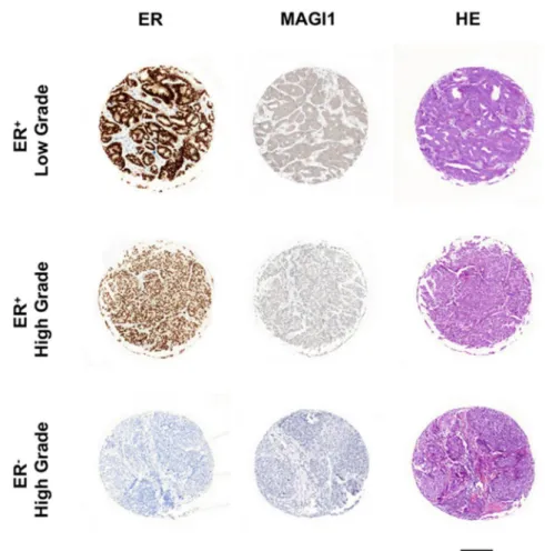 Figure 5. Immunohistochemical analysis of ER and MAGI1 expression in human breast cancers