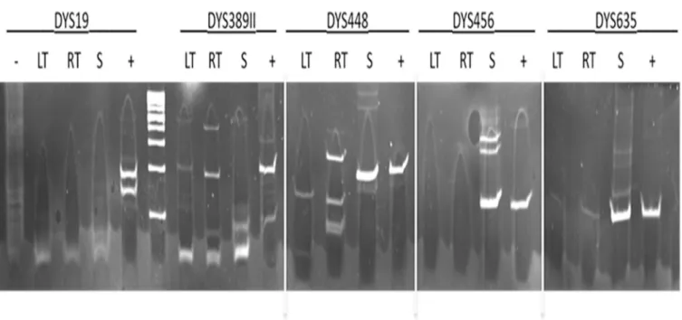 Fig 4. PCR amplification of 5 STRs from the Y chromosome. Left tibia (LT), right tibia (LT), petrous bone (S), negative control (-), positive control (+).