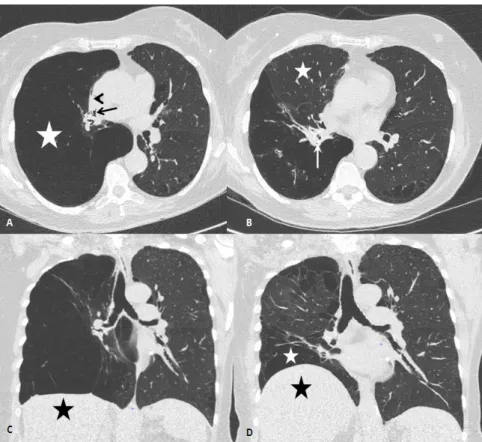 Figure 1. Chest computed tomography before and after endobronchial valves treatment. (A) Axial  chest computed tomography (CT) at the level of the right middle bronchus (black arrow), before  endobronchial valve treatment, showing complete atelectasis of t