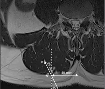 Fig. 2. Biopsy of the right paraspinal muscle. Distance between spinous  process and biopsy site, 40 mm; biopsy angle, 35°; normal biopsy depth  from fascia (#) into muscle (*), 22 mm.