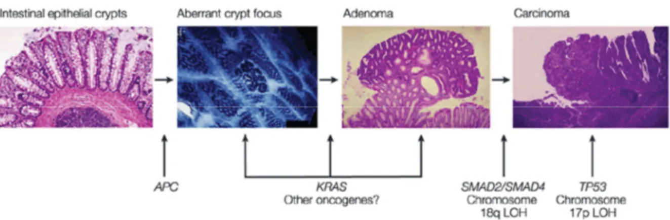 Figure 11. Histological features and key oncogenic events during colorectal cancer evolution   (Adapted from Fearon and Vogelstein, 1990)