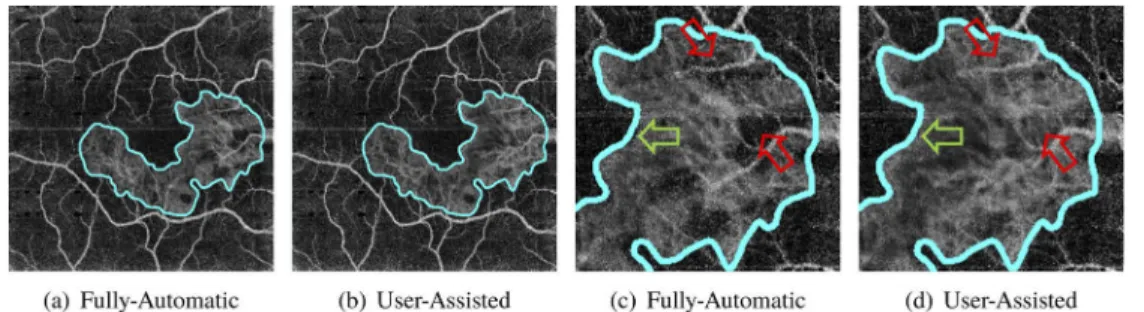Fig. 8. Effect of user-assisted segmentation on visualization of CNV lesion. User-assisted segmentation was performed as described in Fig