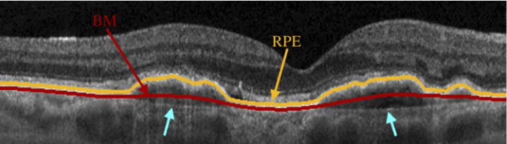 Fig. 2. Example of fully-automatic segmentation of the RPE and Bruch’s membrane in an OCT B-scan that intersects a CNV lesion