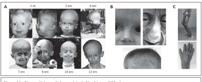 Figure 18 - Signes cliniques de la progéria de Hutchinson-Gilford  A. Evolution de l’apparence physique d’un patient entre 1 an et 12 ans