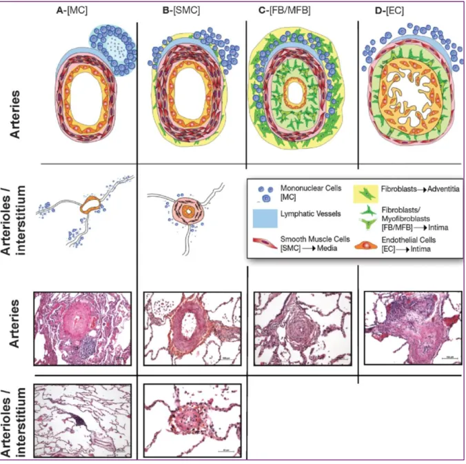 FIGURE 4 : Schéma et exemples concrets des différentes lésions vasculaires pulmonaires  typiques de l’HTAP (Guignabert C