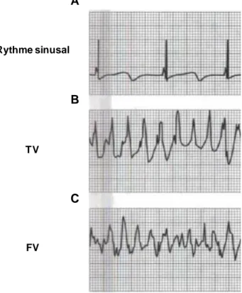 Figure 22. Exemples d'arythmies cardiaques. Représentation d’enregistrements d’ECG chez un sujet masculin  âgé de 12 ans en rythme sinusal (A), lors d’un épisode de TV (B) et de FV (C)
