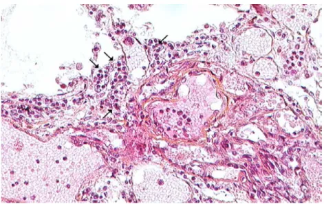 Figure 11 : lésion plexiforme chez un patient HTAP sévère 63 .  La lésion présente des infiltrats inflammatoires lymphatiques