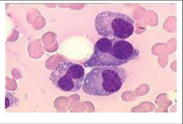 Fig. 6:Image histopathologique d'un myélome multiple). Coloration à l'hématoxyline et à  l'éosine ( Raab et al., 2009)