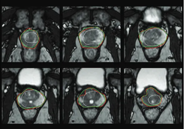 Figure 1.10 – R´esultats des segmentations manuelle et automatique par notre m´ethode (MMAP) : superposition des contours repr´esent´es, respectivement en vert et en rouge, sur des images axiales d’une prostate pr´esentant une tumeur au niveau du lobe droi