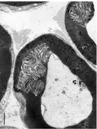 Figure 11. TEM of adjacent obese Zucker rat sciatic nerve fibers with internodal, variable size, enlarged demyelinating sectors and their narrow Cajal bands with pale vacuoles
