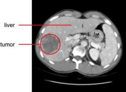 Figure 1-2: Axial view of the liver CT slice containing a tumor as a darker region indicated by red circle 