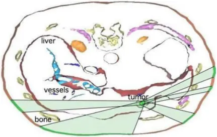 Figure  ‎ 1-5 Avoiding risky regions is shown for cryosurgery planning. Ribs, vessels and spine are avoided taken from [10] 