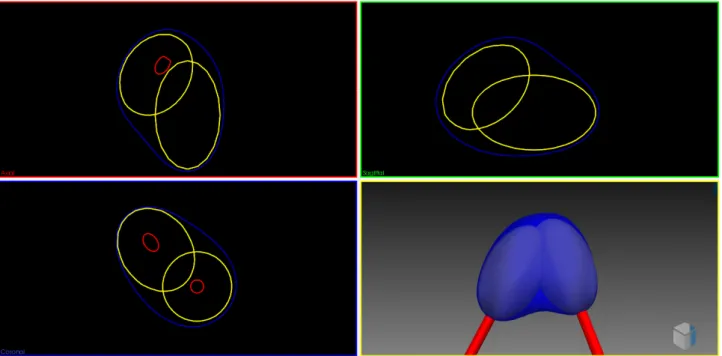 Figure 4-5 Synergic effect of two needles on the simulated iceball comparing to separate ellipsoids