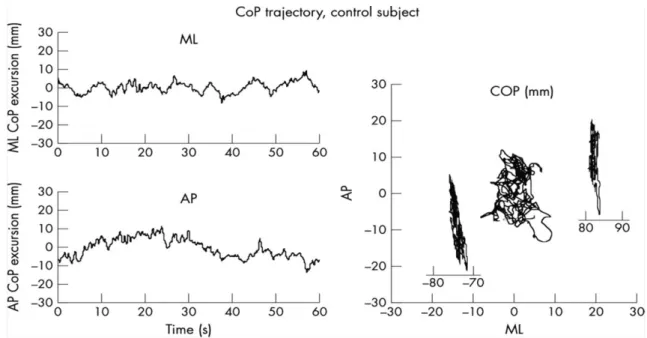 Figure 12 : Trajectoire du centre de pression des pieds (CP) chez un sujet sain. A gauche :  Excursion monodirectionnelle du CP dans les directions médio latérale (ML) et antéropostérieure  (AP)