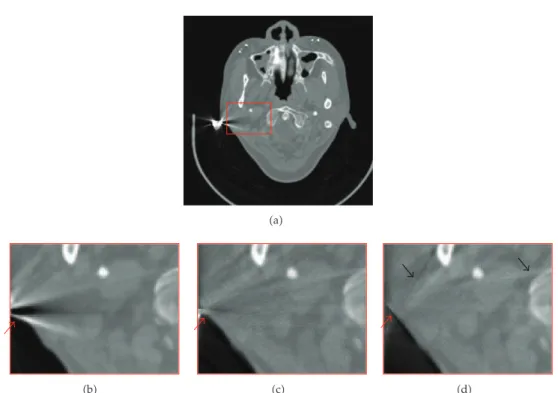 Figure 6: Artifact correction on ClinicalImage2. a Original CT image with artifacts; b zoomed ROI in the original image;  c  zoomed ROI in the result image obtained from Bal’s algorithm;  d  zoomed ROI in the result image obtained from the proposed method.