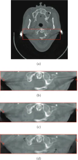 Figure 7: Artifact correction on ClinicalImage3.  a  Original CT image with artifacts;  b  zoomed ROI in the original image; c zoomed ROI in the result image obtained from Bal’ algorithm; d zoomed ROI in the result image obtained from the proposed method.
