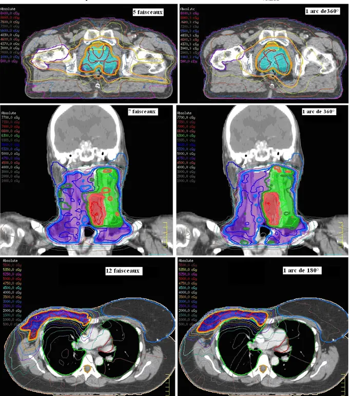 Fig. 1.  Distribution de dose correspondant à la technique S&amp;S à gauche et au VMAT à droite pour trois  localisations : prostate, ORL en boost intégré, paroi avec chaine mammaire interne