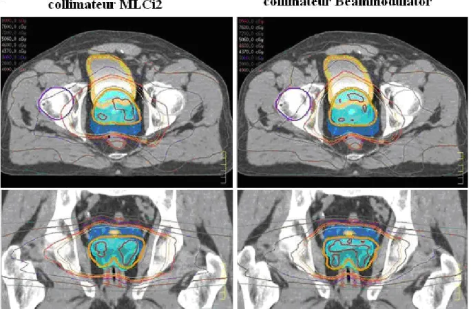 Fig. 5.  Distributions de dose réalisées avec le MLCi2 (à gauche) et le Beam Modulator (à droite), dans des  coupes transversales (en haut) et coronales (en bas) pour un cancer de la prostate traité à 80 Gy 