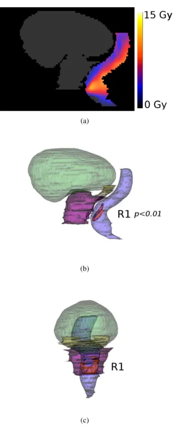 Figure 6. Results of voxel-wise analysis in the template space for rectal bleeding. a) Mean differences in dose between the two groups