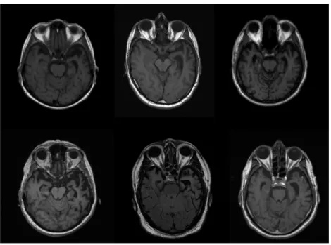 Figure 1. Anatomical brain scans. Top row, from left to right: P1, P2, and P3. Bottom row, from left to right: P4, P5, and P6