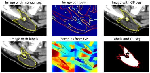 Fig. 2: Gaussian process segmentation of parotid gland. The initial label from the atlas-based segmentation only partially agrees with the manual segmentation.