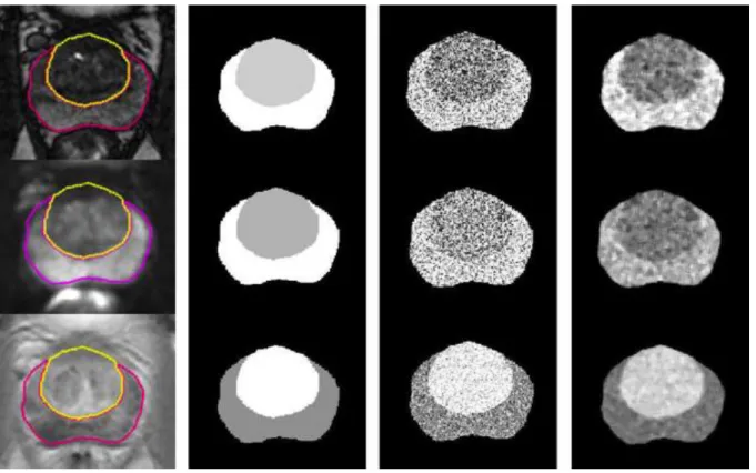 Figure  3:  The  image  simulation  process.  From  left  to  right:  original  MRI  with  pre-delineated  peripheral  and  transition  zones,  the  zones  labeled  with  their  respective  mean  level,  data  with  Gaussian  noise  and  data  after  a  sm