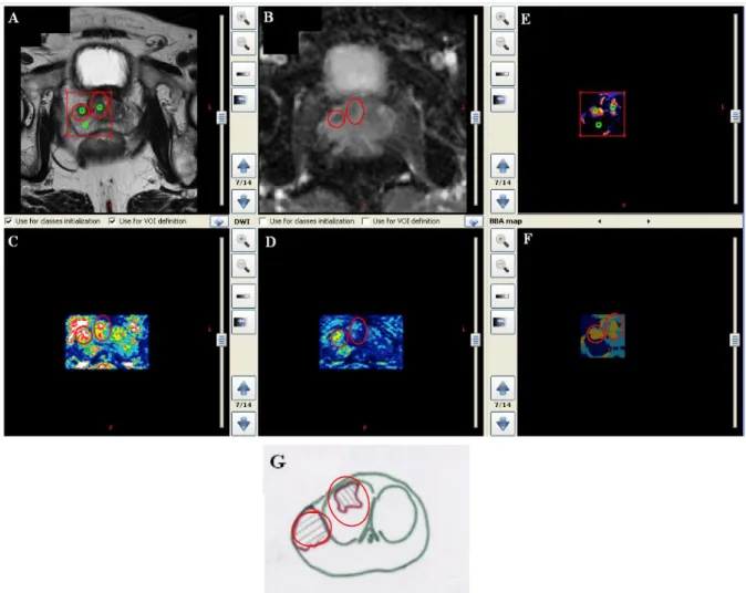 Figure  6: Classification results – Example 1. (A) T2W image with the region of interest to be analyzed