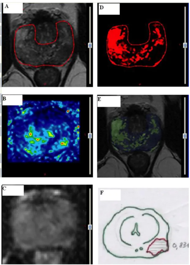 Table 2 summariesthe histopathology data for the 15 patients and the results quantified using  the sensitivity and specificity