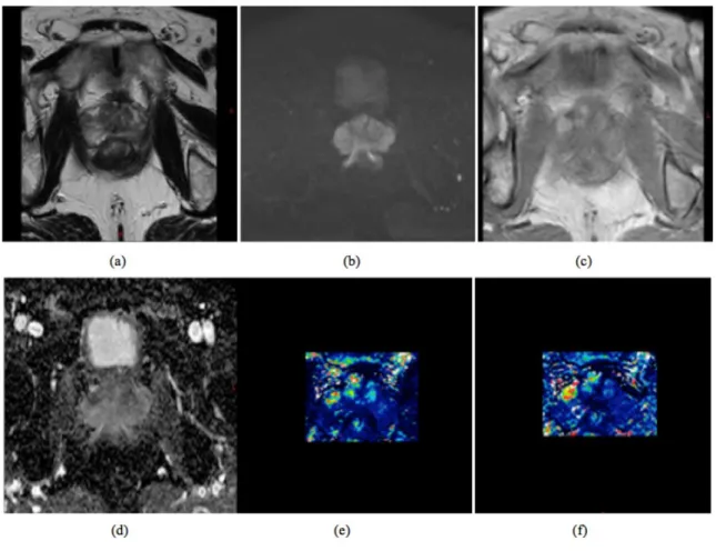 Figure 1: Examples of multiparametric magnetic resonance images: (a) T2 weighted sequence, (b) diffusion  weighted images (DWI), (c) T1 weighted dynamic contrast enhance (DCE) images, (d) the apparent diffusion  coefficient map computed from the diffusion 
