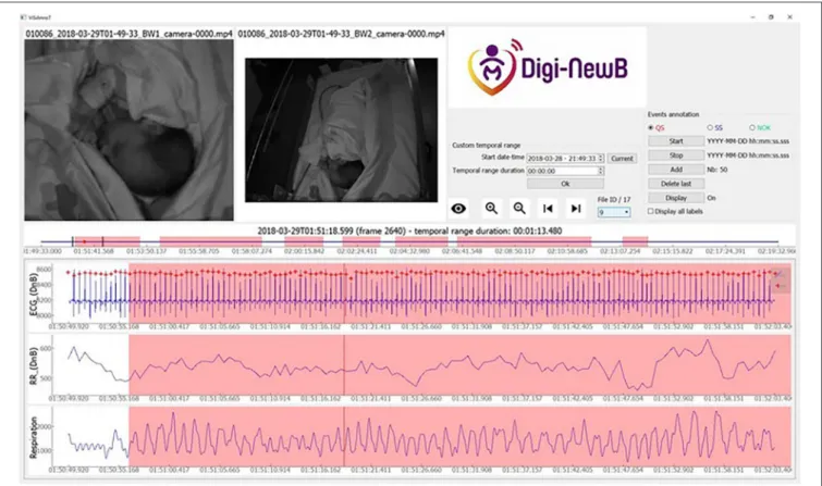 FIGURE 1 | Screenshot of ViSiAnnoT software displaying two videos and three signal plots, for a preterm infant at 35+5 days PMA