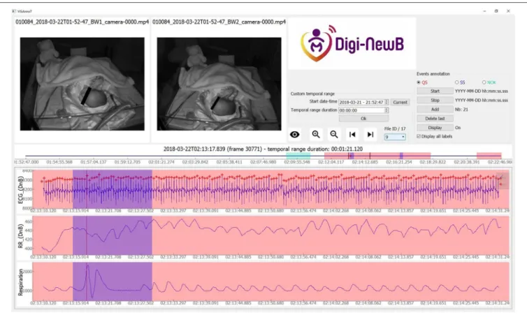FIGURE 2 | Screenshot of ViSiAnnoT software illustrating a startle in a newborn at 37+1 days PMA