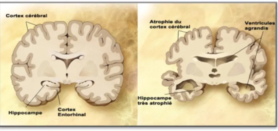 Figure 1.  Schéma de l’évolution de la maladie d’Alzheimer sur le cerveau. (Dubuc,  n.d.) 