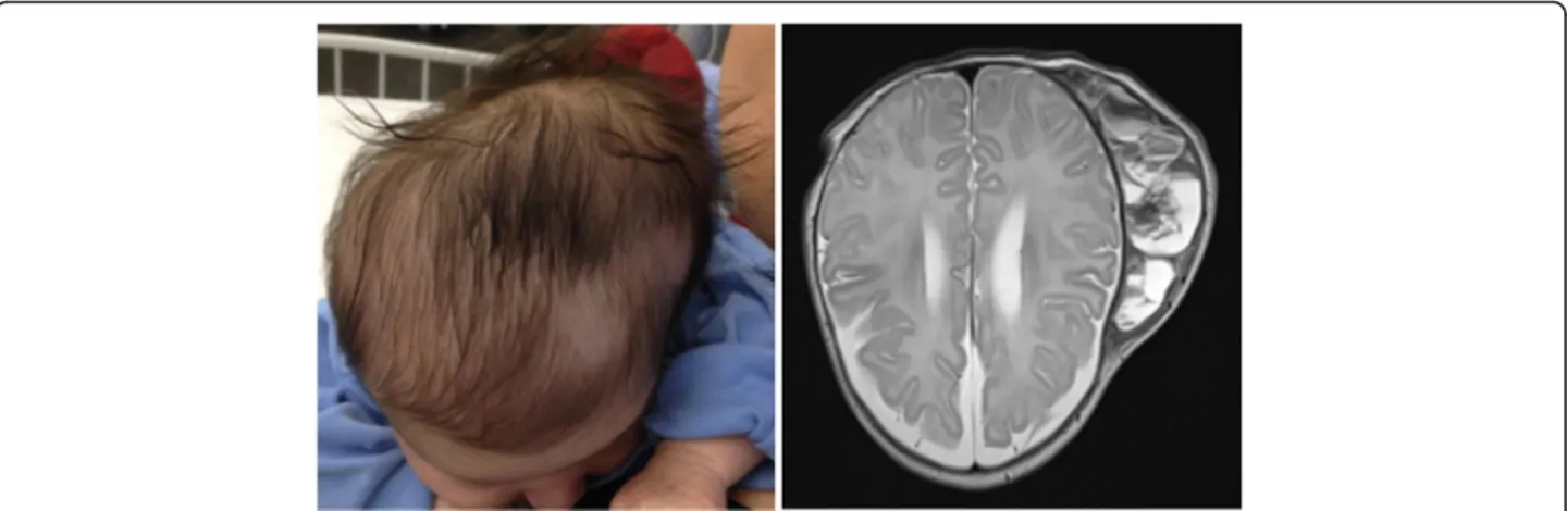 Fig. 1 Clinical presentation and magnetic resonance imaging findings of the 5-week-old girl with infected cephalhaematoma