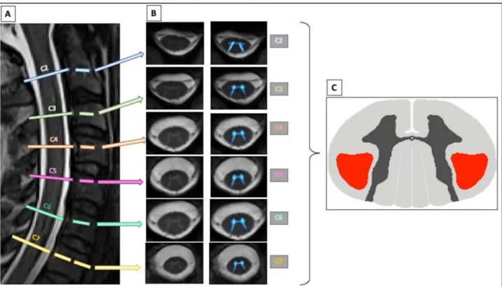 Figure  1.  The  multiparametric  cervical  spinal  cord  MRI  protocol  here  exemplified  in  a  C9-  negative subject  includes  (A)  a  T2-weighted  SPACE  sagittal  sequence  for  vertebral  levels  identification,  (B) an axial high-contrast 2D T2*-w
