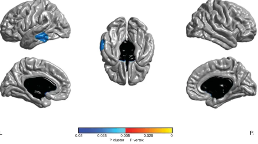 Fig. 1. Cluster with significant cortical thickness changes in aGRN+ between the two time-points (p&lt; 0.05 corrected)