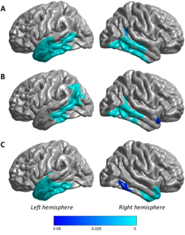 Figure  4    Regions of significantly reduced cortical thickness in PPA patients versus healthy  controls