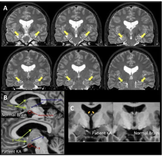 Figure 2. (A) Patient KA’s T2-weighted MRI scans. Yellow arrows indicate bilateral hippocampal atrophy; (B)  Fornix, mammillary bodies and mammillo-thalamic tract abnormalities in patient KA (bottom) vs a healthy 