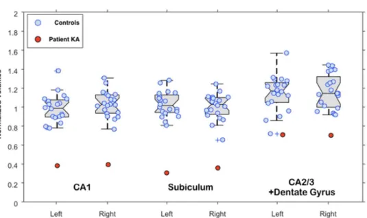 Figure 3. Hippocampal subfields volumetry in patient KA vs 20 healthy controls. (Crawford’s modified t-tests,  all p values <0.05)