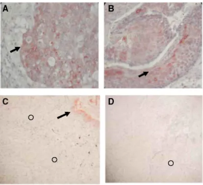Figure 5: Immunohistochemistry.  Paraffin sections of adenocarcinoma (A) and squamous cell lung cancer (B) were subjected to  ADAM-12 immunohistochemistry as reported in the Materials and Methods section