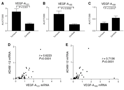 Figure 4: VEGF-A 121  and VEGF-A 165  mRNA levels are more elevated in tumour samples (T) (P&lt;0.05)  (A-B) while  VEGF-A 189  mRNA levels are lower in the squamous carcinomas and adenocarcinomas (P&lt;0.001) (C)