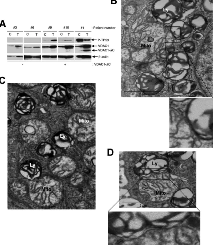 FIG 6 Truncated VDAC is present in lysates of lung adenocarcinoma tissue from patients, and tumor tissue sections show a close interaction between mitochondria and lysosomes