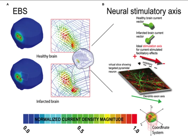 FIGURE 1 | Current density distribution maps induced by EBS stimulation. In (A), the left column depicts the current density magnitude for the corresponding healthy intact (top) and infarcted (bottom) brains stimulated with EBS