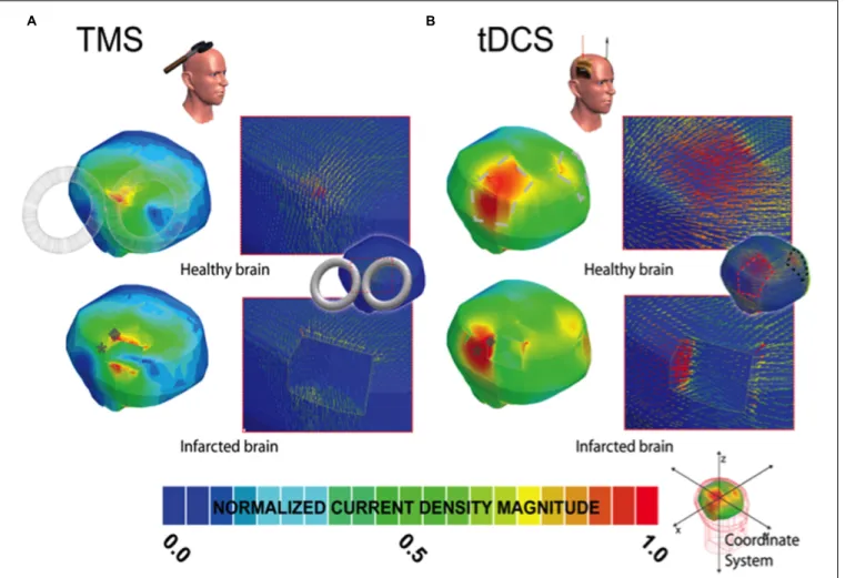 FIGURE 2 | Current density distribution maps induced by TMS and tDCS stimulation. In (A,B), the left column depicts the current density magnitude for the corresponding healthy or intact (top) and infarcted (bottom) brains stimulated with TMS and tDCS, resp