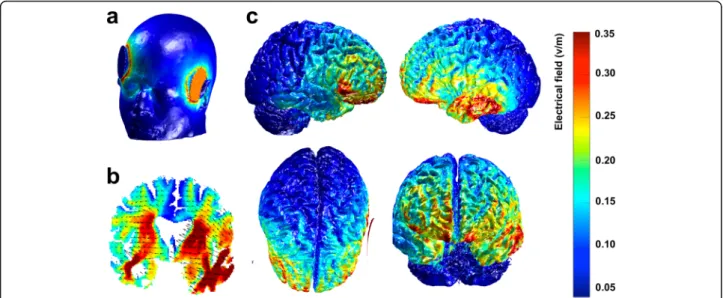 Fig. 5 Example of a computational model produced with the open-source tool ROAST for the simulation of transcranial direct current stimulation (tDCS) current magnitude and distribution using a 3D T1-weighted image from a representative SD patient